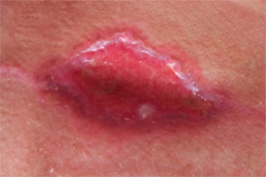 Deiscência de sutura